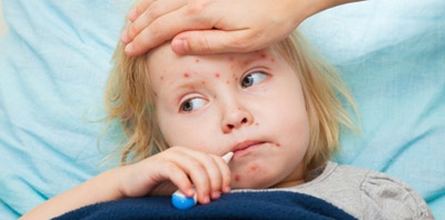 https://dl.greenbeautymag.com/2020/05/measles-fever-e10.jpg