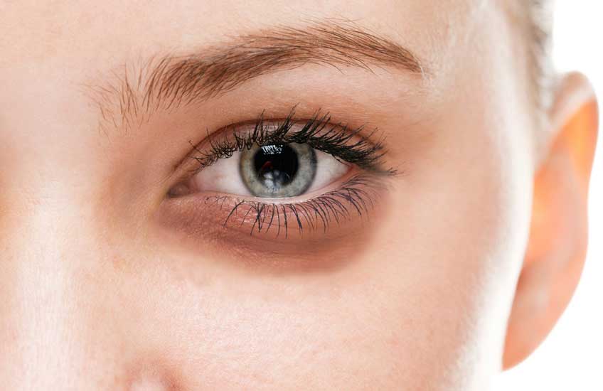 7 روش خانگی برای از بین بردن پف زیر چشم