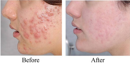 https://dl.greenbeautymag.com/2020/12/vulgaris-acne-treated-2.jpg