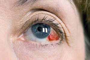 لکه های قرمز داخل چشم چه رازهایی درباره سلامت شما دارند؟