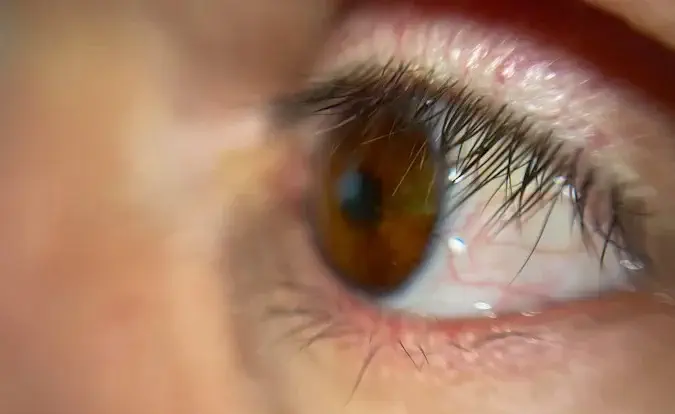 یک بیمار اولین چشم مصنوعی ساخته شده با پرینتر سه بعدی را دریافت کرد