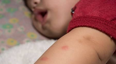 درمان و پیشگیری از نیش زدن پشه در کودکان