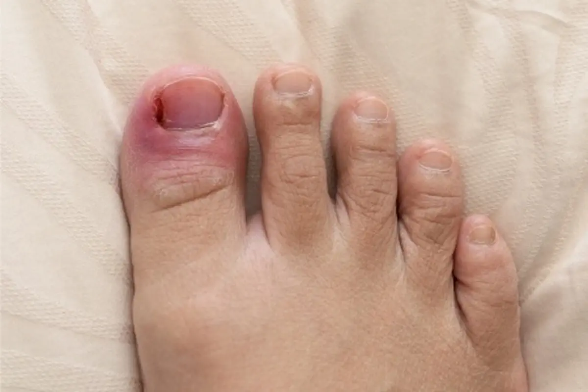 علل و نشانه های عفونت ناخن پا