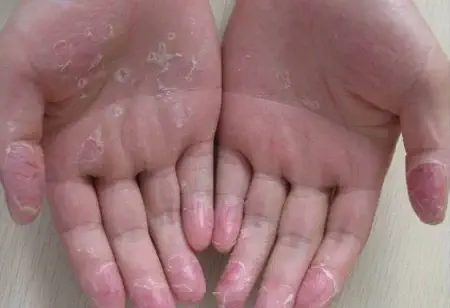 پوست پوست شدن دست: علل و راههای درمان