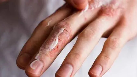 پوست پوست شدن دست: علل و راههای درمان