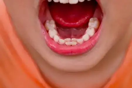علت دیر افتادن دندان‌ شیری کودکان