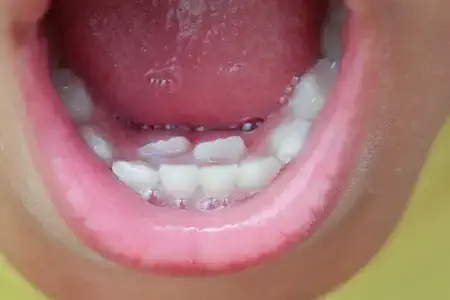 علت دیر افتادن دندان‌ شیری کودکان