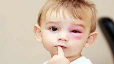سلولیت چشمی در کودکان چیست؟ علل، علائم و درمان آن کدام است؟