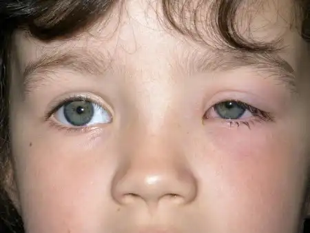 سلولیت چشمی در کودکان چیست؟ علل، علائم و درمان آن کدام است؟