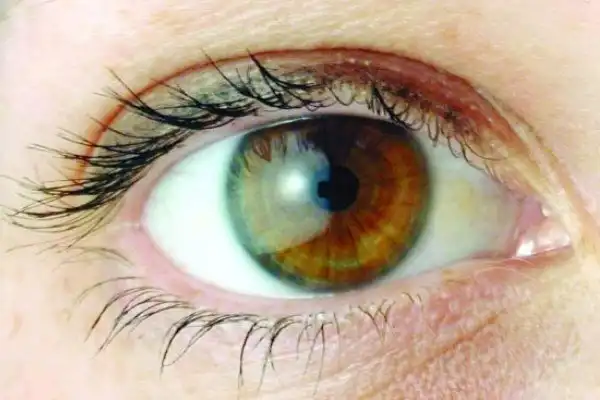 علائم و نحوه پیشگیری از آب سیاه چشم را بدانید