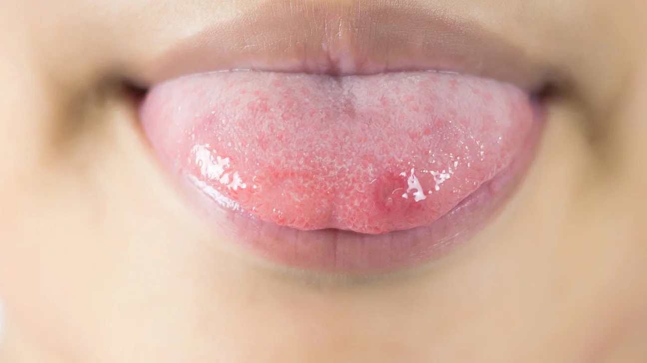 علت زخم شدن زبان و راهکارهایی برای درمان و پیشگیری