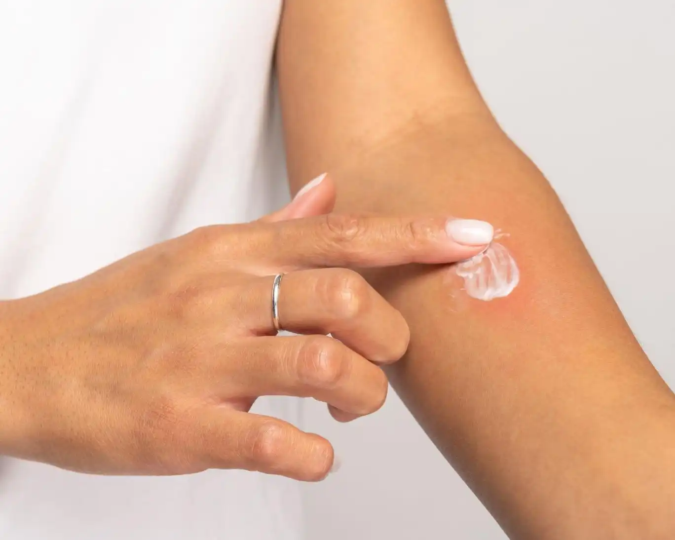 افزایش امیدواری‌ها نسبت به تولید کرم درمان سرطان پوست