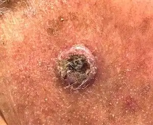 کدام لکه های پوستی خطرناکند؟ 2 کدام لکه های پوستی خطرناکند؟