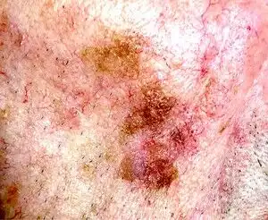 کدام لکه های پوستی خطرناکند؟ 3 کدام لکه های پوستی خطرناکند؟