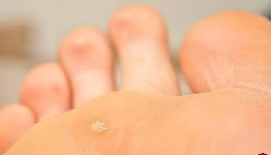 میخچه پا؛ علل، درمان و پیشگیری از مشکلات پوستی در پا