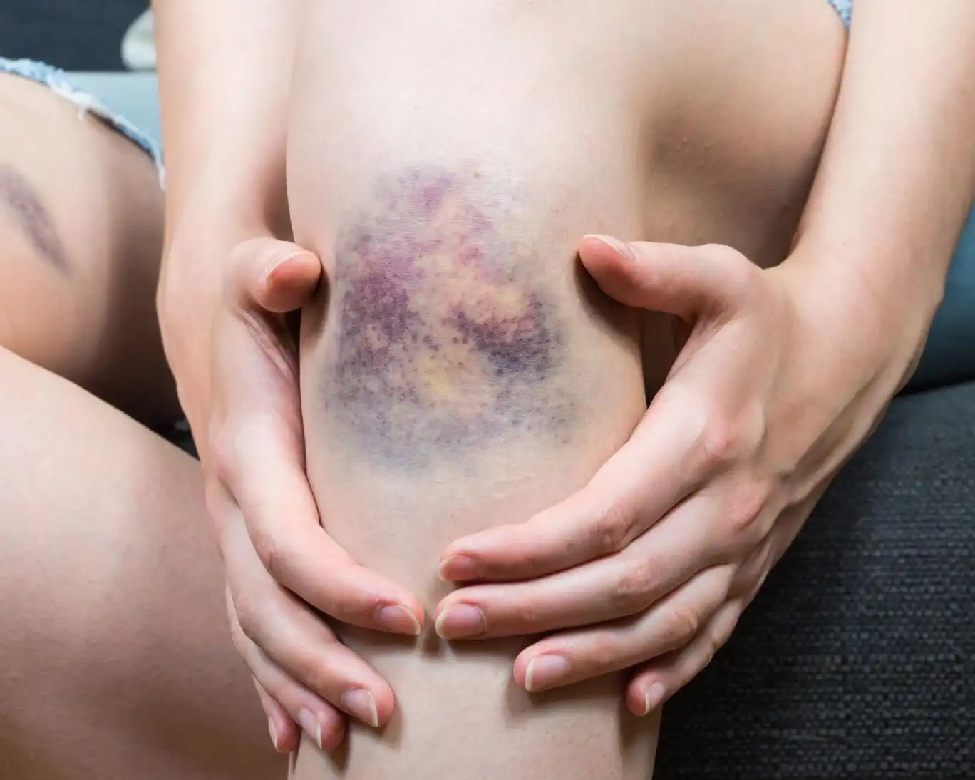 هفت دلیل کبود شدن سریع پوست